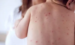 موثرترین راه پیشگیری از بیماری سرخک و سرخجه واکسیناسیون است