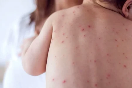 موثرترین راه پیشگیری از بیماری سرخک و سرخجه واکسیناسیون است